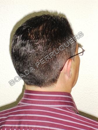 Prevenció i tractament de la caiguda del cabell Boada Perruquers